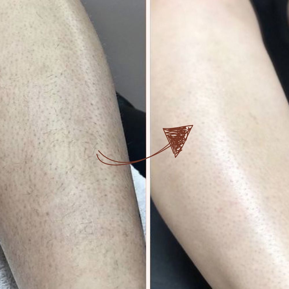 Diamond IPL Pro